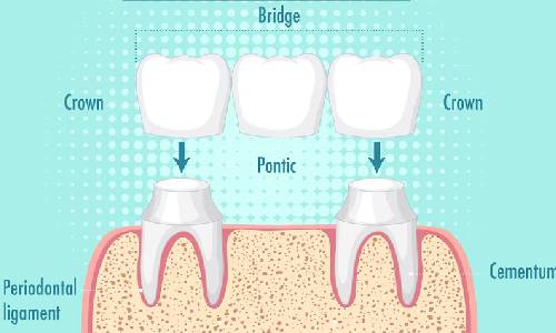 Dental Crown Bridges
