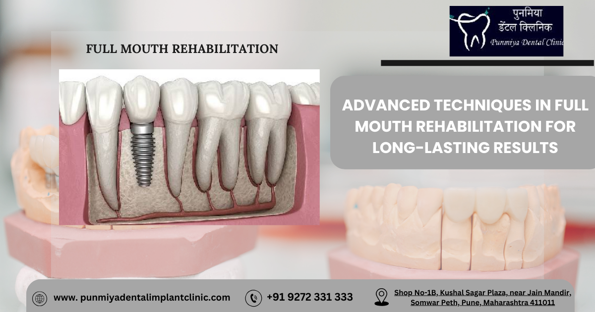 Full mouth dental implants